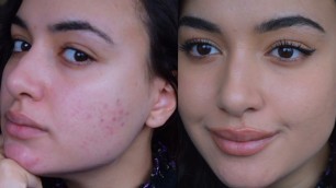 'HOW TO LIGHTLY COVER ACNE MARKS WITH BAREMINERALS POWDER FOUNDATION| little coverage makeup acne'