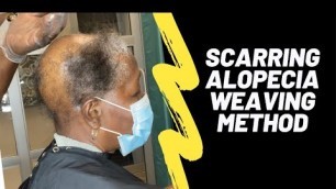 'Scarring Alopecia | Alternate weaving method'