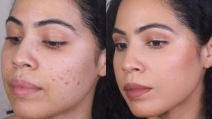 'Covering Acne, Scars and Hyperpigmentation Using CLEAN DRUGSTORE Makeup'