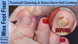 'TOE HOLE UPDATE  | Toenail Cleaning and Rams horn nail cutting by Miss Foot Fixer Marion Yau'
