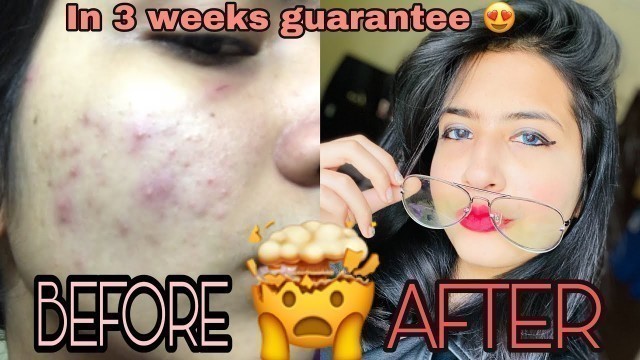 'GET RID OF ACNE AND GET GLOWING SKIN- ‘SECRET REVEALED’