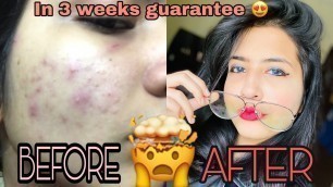 'GET RID OF ACNE AND GET GLOWING SKIN- ‘SECRET REVEALED’ 