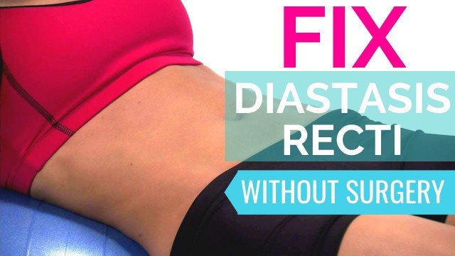 'How To Fix Diastasis Recti | Heal Diastasis Recti Naturally Without Surgery'