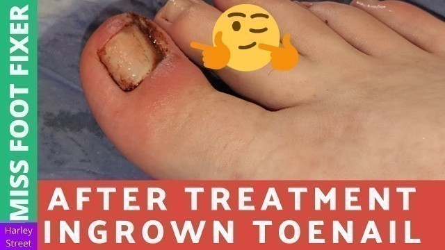 'After Treatment Video | Ingrown toenail Treatment | Miss Foot Fixer | Marion Yau'