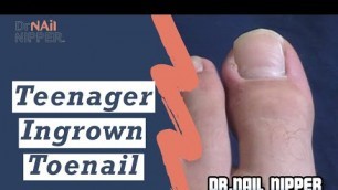 'Teenager Ingrown Toenail (2019)'