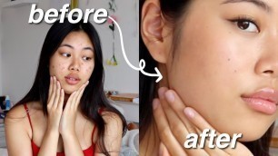 'how I cover acne with makeup'