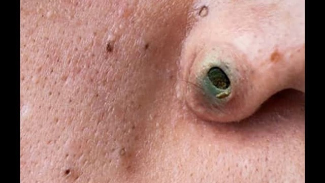 'Nose Blackheads, Chin Zits and Biggest Pimples - Top 10 Searches'
