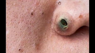 'Nose Blackheads, Chin Zits and Biggest Pimples - Top 10 Searches'