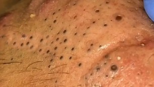 'Extreme Cysts, Top 3 Cysts, Top 10 Biggest Blackheads - Top Searches'