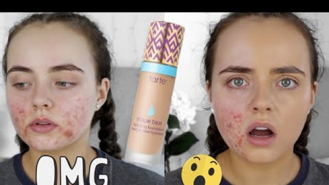 'TARTE SHAPE TAPE FOUNDATION REVIEW | ACNE PRONE SKIN | Conagh Kathleen'