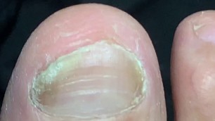 'DRILL BABY DRILL: THE PATHFORMER TREATMENT FOR TOE NAIL FUNGUS 