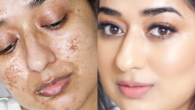 'How To Cover Acne Scars Using Only Two Products | Simor Singh'