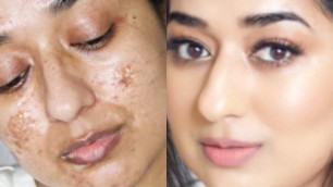 'How To Cover Acne Scars Using Only Two Products | Simor Singh'
