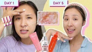 'My (hormonal) acne came back... here\'s what I did.'