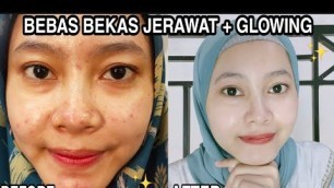 'RAHASIA WAJAH GLOWING BEBAS BEKAS JERAWAT 2020 | by Syaquina Skincare'