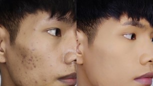 'HOW TO COVER ACNE AND BLEMISHES || MIZO MAKEUP TUTORIAL || Franky Fanai'