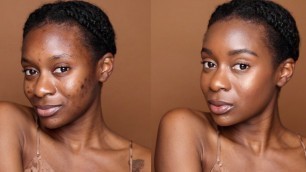 'Cover Acne & Dark Marks WITHOUT FOUNDATION | Minimalist Makeup For Acne'