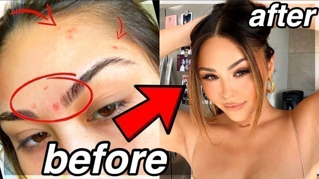 'How To Conceal Acne/Acne Scars *flawless foundation routine* | Roxette Arisa'