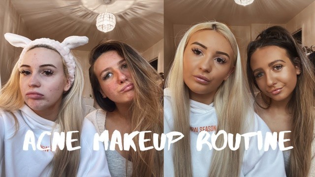 'OUR ACNE MAKEUP TUTORIAL - HOW WE COVER OUR ACNE!!!'