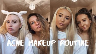 'OUR ACNE MAKEUP TUTORIAL - HOW WE COVER OUR ACNE!!!'