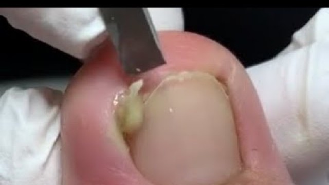 'Suppurative nail treatment'
