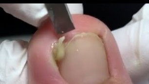 'Suppurative nail treatment'