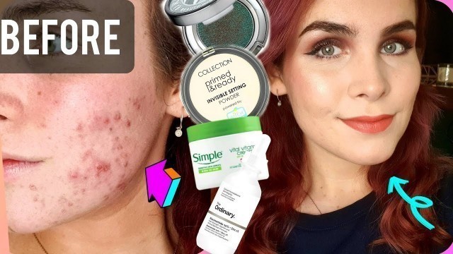 'Easy Makeup to Help Cover Acne/Problem Skin'