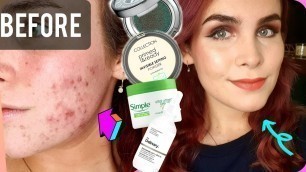 'Easy Makeup to Help Cover Acne/Problem Skin'