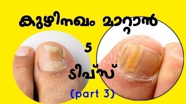 'കുഴിനഖം മാറാൻ 5 ടിപ്സ് | toenail fungus | kuzhi nagam treatment | malayalam health tips'
