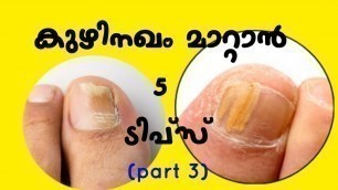 'കുഴിനഖം മാറാൻ 5 ടിപ്സ് | toenail fungus | kuzhi nagam treatment | malayalam health tips'