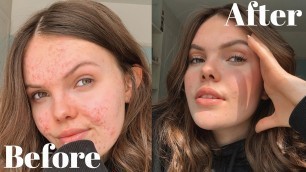 'EVERYDAY MAKEUP FOR ACNE & HOW TO APPLY MAKEUP OVER ACNE | Eleri Bowen'
