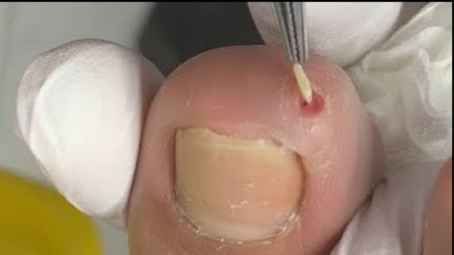 'The worst toenail on earth! “Thorn\" inside the toe -'