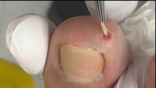 'The worst  toenail  on earth!  “Thorn\" inside the toe -'