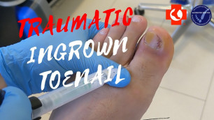 'TRAUMATIC PAINFUL INGROWN TOENAIL'