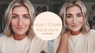 'HOW I COVER ADULT ACNE | Tips for full coverage foundation'