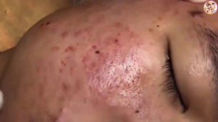 Dr. Acne Removal Skincare #acne #blackheads #whiteheads #skintreatment #skincareroutine #glowing