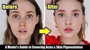 'How I Cover My Acne, Acne Scars, & Skin Pigmentation | A Model\'s Tips *Easy, Non-Cakey*'