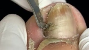 'Thick toenail treatment'