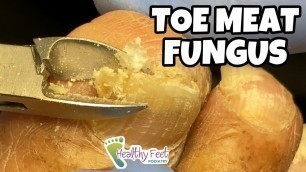 'TRIMMING AROUND MOIST TOE MEAT UNDER THICK FUNGUS TOENAILS!'