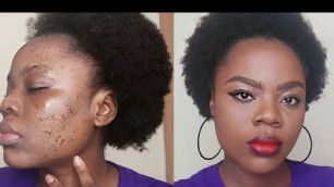 'ACNE FOUNDATION ROUTINE | HOW TO COVER DARK SPOTS | LA FRANCES'