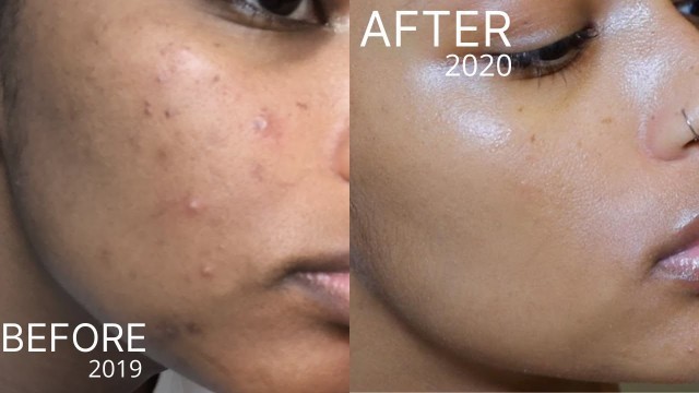 Simple/Affordable Skincare Routine for Acne/Scars/Hyperpigmentation | MIRACLE PRODUCTS