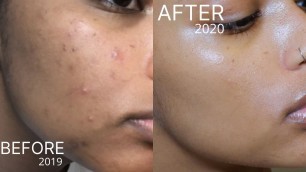 Simple/Affordable Skincare Routine for Acne/Scars/Hyperpigmentation | MIRACLE PRODUCTS