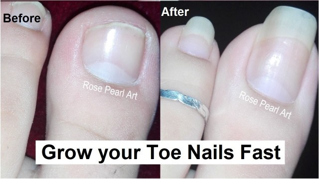 'How to Grow Toe Nails Healthy and Fast- IMPORTANT STEPS- Toenail Growth Journey | Rose Pearl'