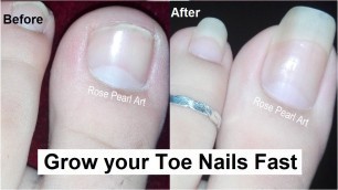'How to Grow Toe Nails Healthy and Fast- IMPORTANT STEPS- Toenail Growth Journey | Rose Pearl'