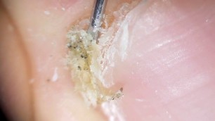 'Toenail deep cleaning. Toenail care. Cutting my toenail.'