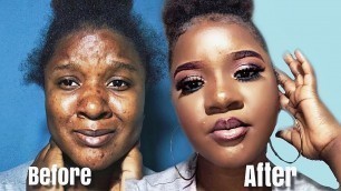 How to Cover Acne Scars, hyperpigmentation and bumps|Beginner Friendly Makeup Tutorial