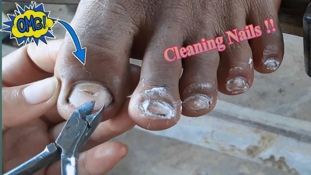 'Unbelievable infected ingrown toenail removal, Infected Big ingrown Toenail Removal, of 2020##'