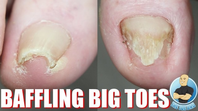 'CURVY & THICK BIG TOENAIL CUTTING TREATMENT'