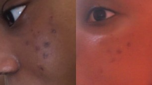 HOW TO FADE YOUR ACNE SCARS IN A WEEK 