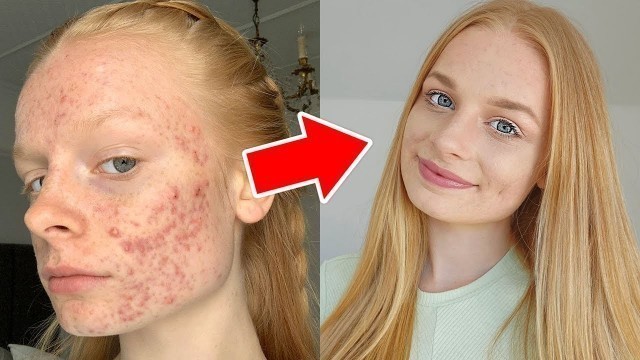 'HOW I COVER MY ACNE grwm + tutorial'